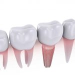 Dental Implants Brisbane